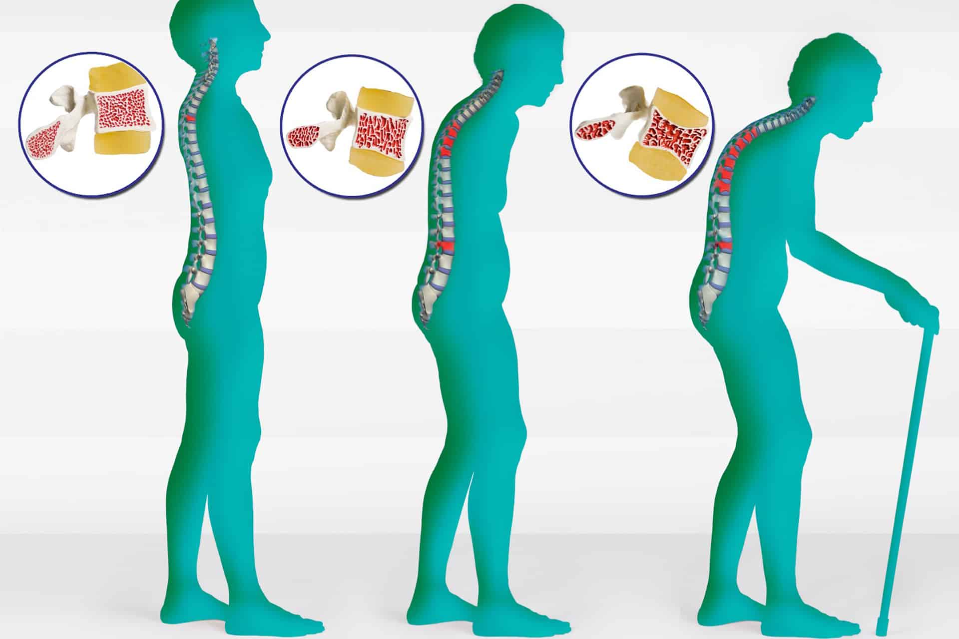 Osteoporosis and Chiropractic Care Mind Body Spine, Victoria, BC