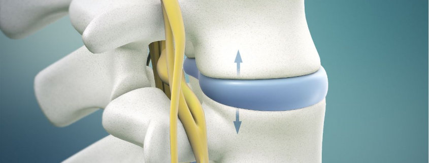 spinal decompression therapy